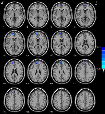 Abnormal Network Homogeneity in the Right Superior Medial Frontal Gyrus in Cervical Dystonia